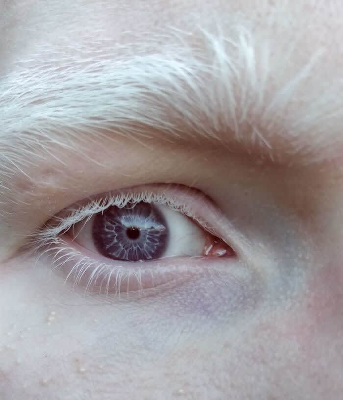 Albinism Causing Lightning Eyes