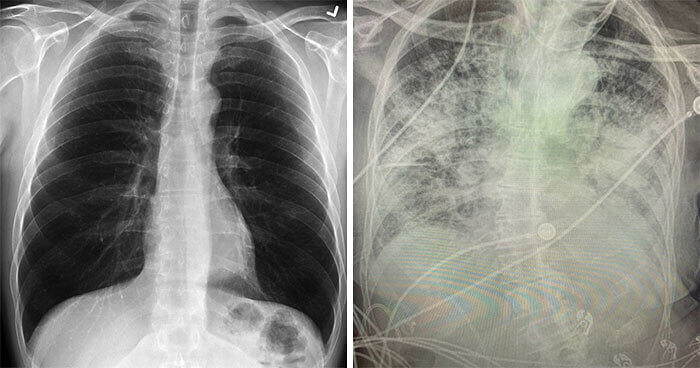 Normal Lungs Vs. COVID-19 Lungs Are Actually Pretty Shocking