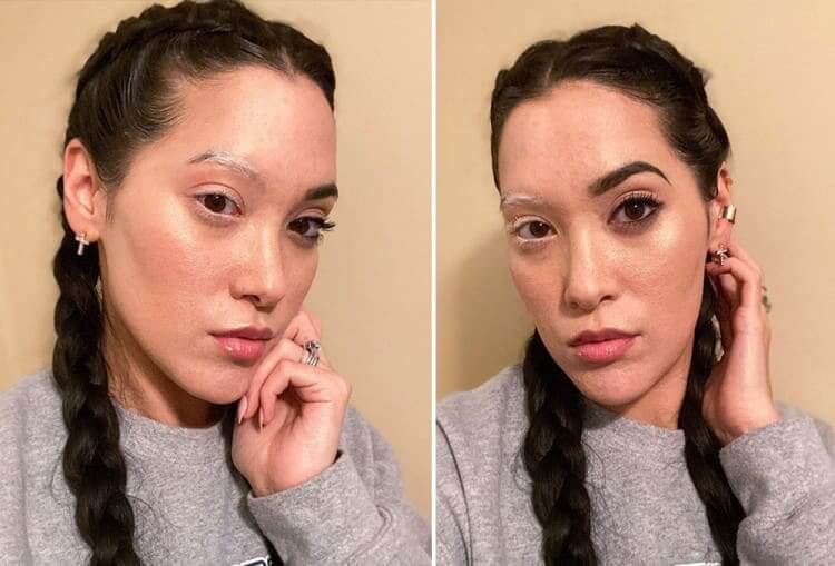 Vitiligo Changes Hair Color On Half Her Face