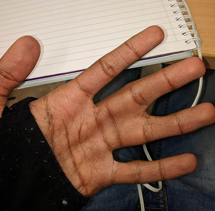 Webbed Fingers