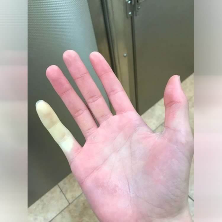 Finger Goes Numb In The Winter