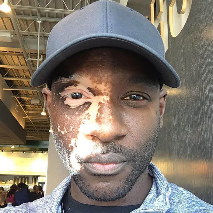 Vitiligo Only On Half Of His Face