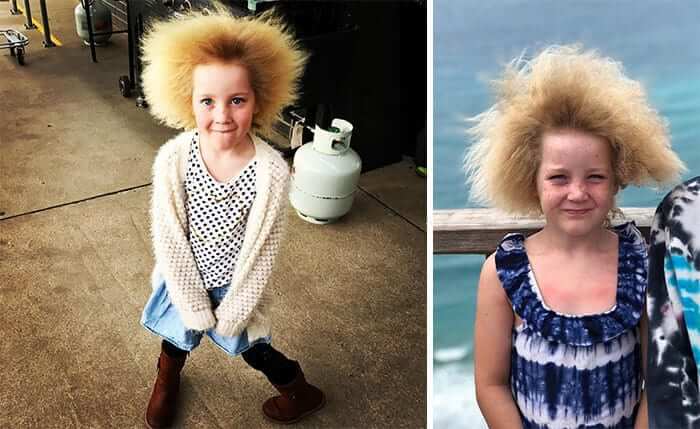 Uncombable Hair Syndrome