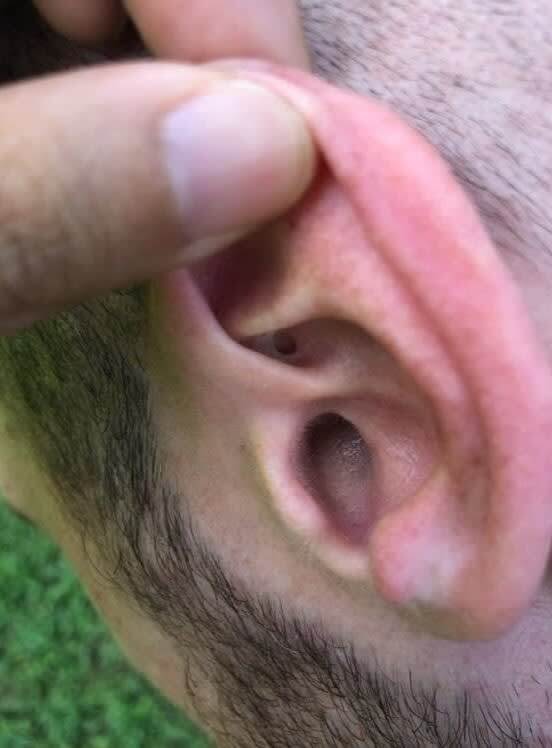 Extra Hole In His Ear