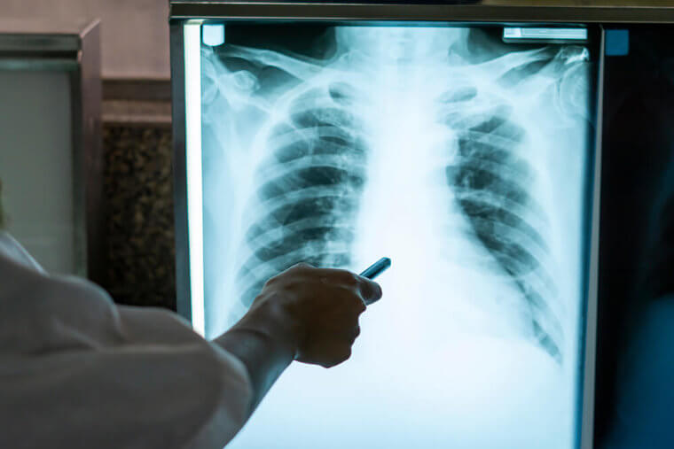 Your Bones Are Stronger Than Steel