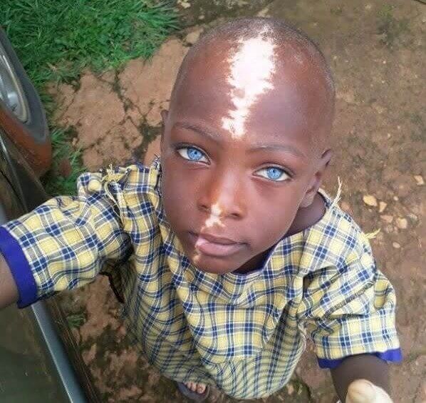 Waardenburg Syndrome