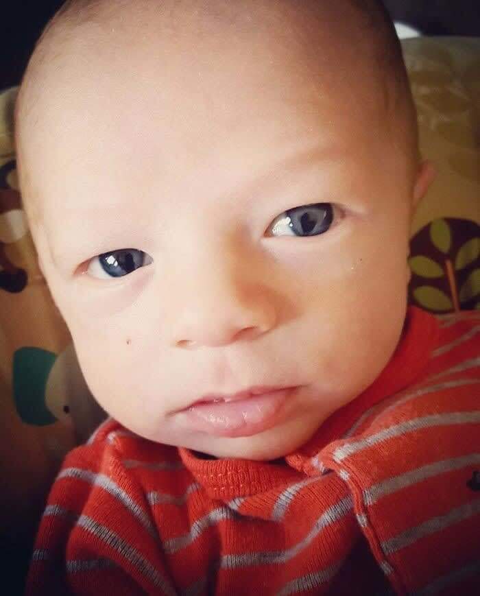 Coloboma In Both Eyes