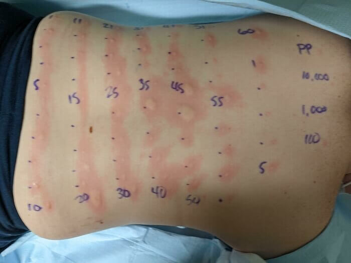 When You're Allergic to Just About Everything